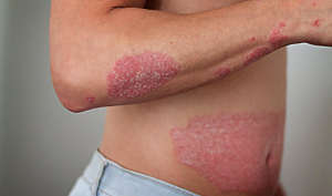 Tips Perawatan Kulit untuk Penderita Psoriasis
