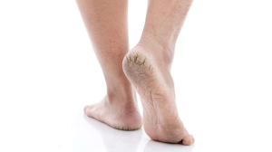3 Gejala dari Terjadinya Kaki Pecah - Pecah